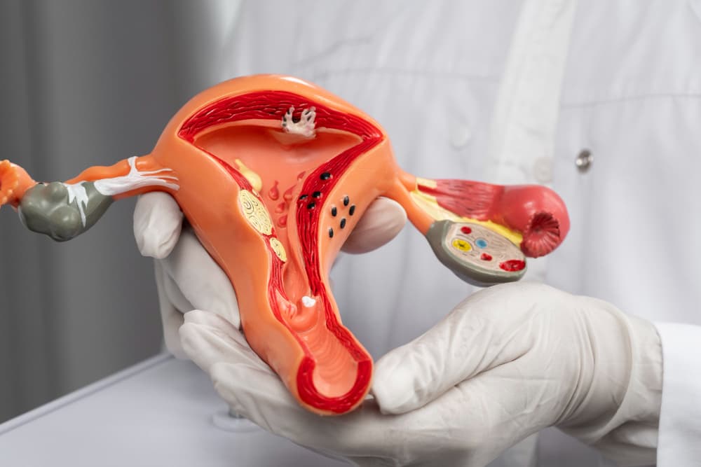 Polikistik Over (PCOS) Nedir?